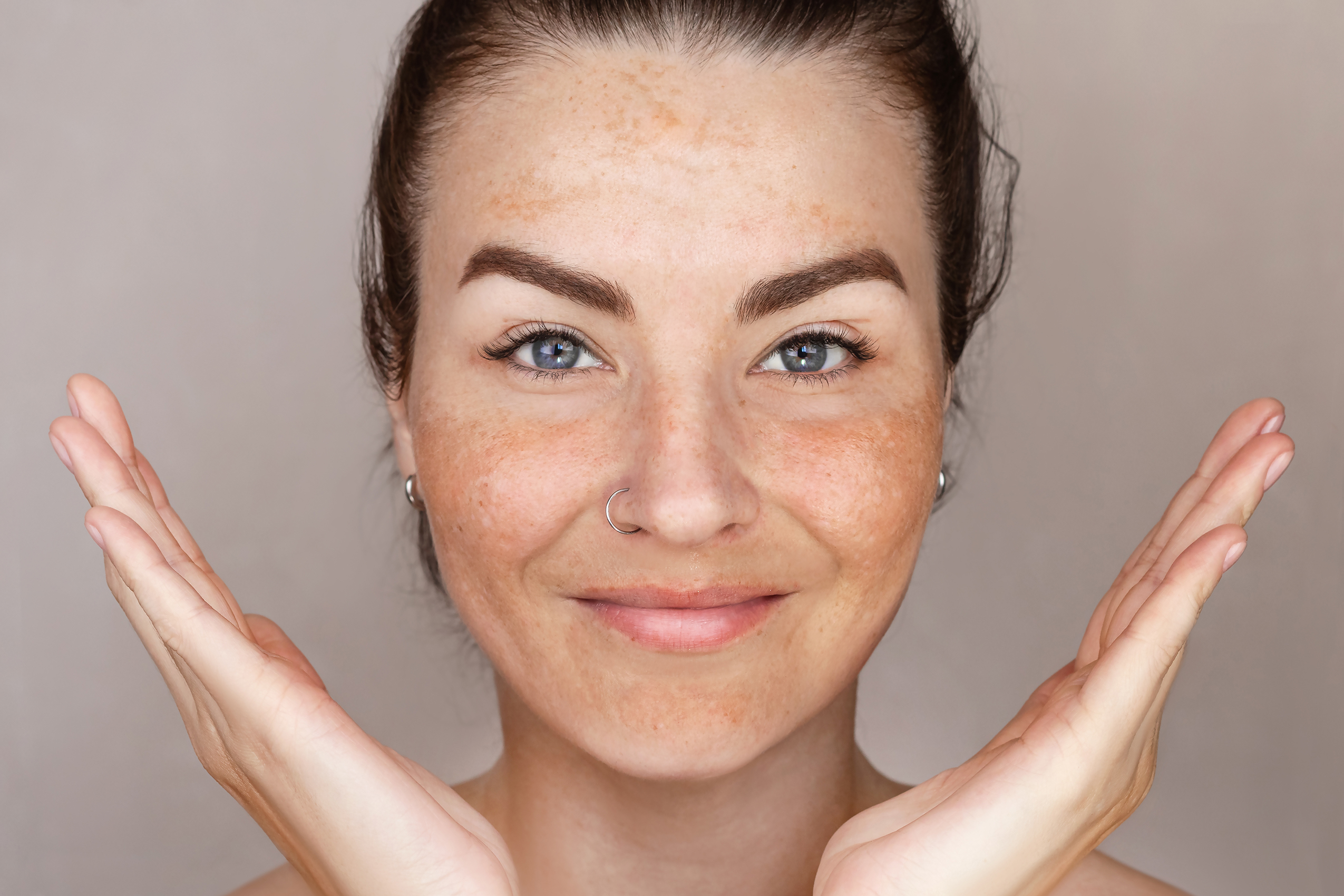 Understanding Hyperpigmentation: What It Is and How to Help Manage It